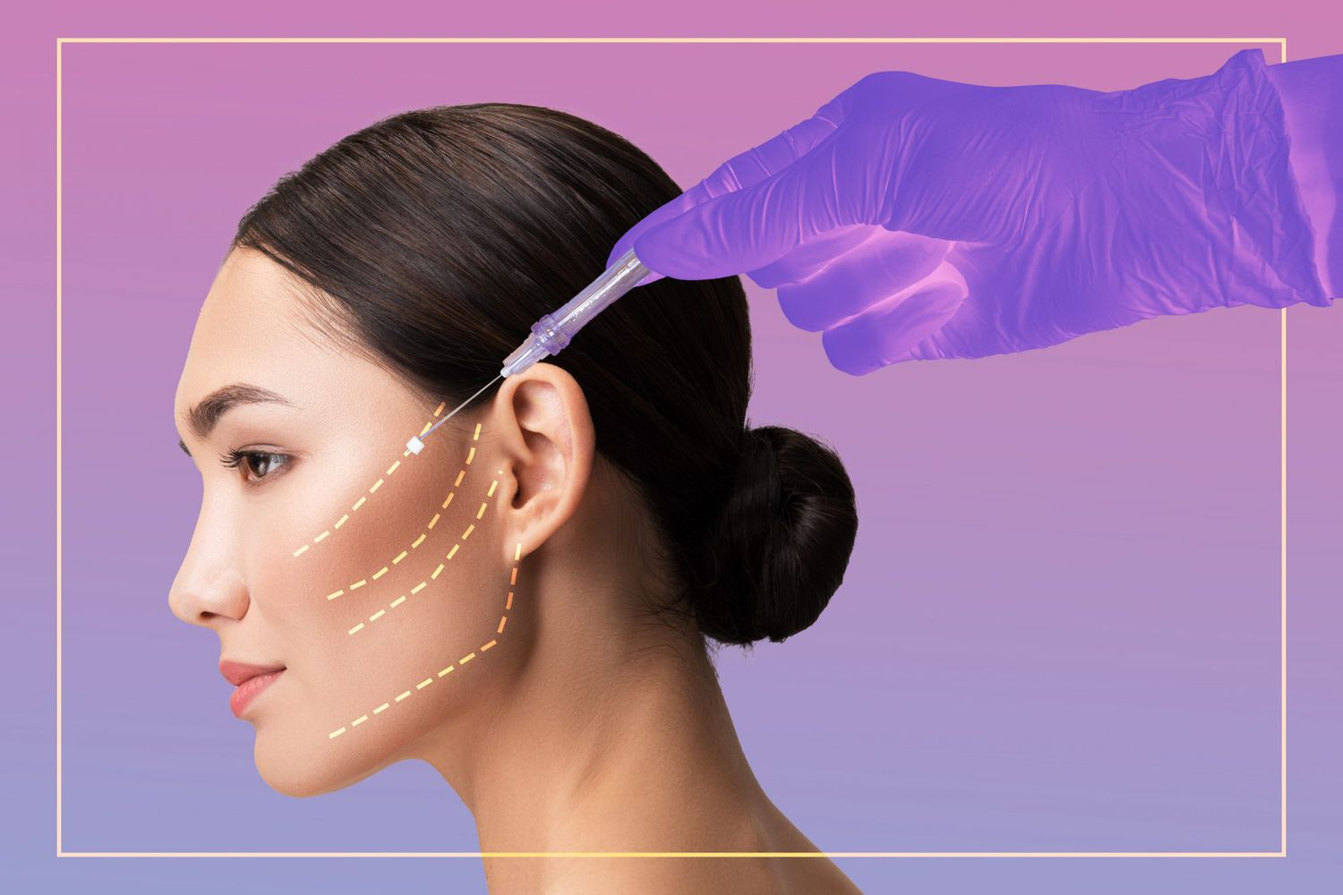 Achieve a V-Line Face with Non-Invasive Thread Lifting and HIFU Technology
