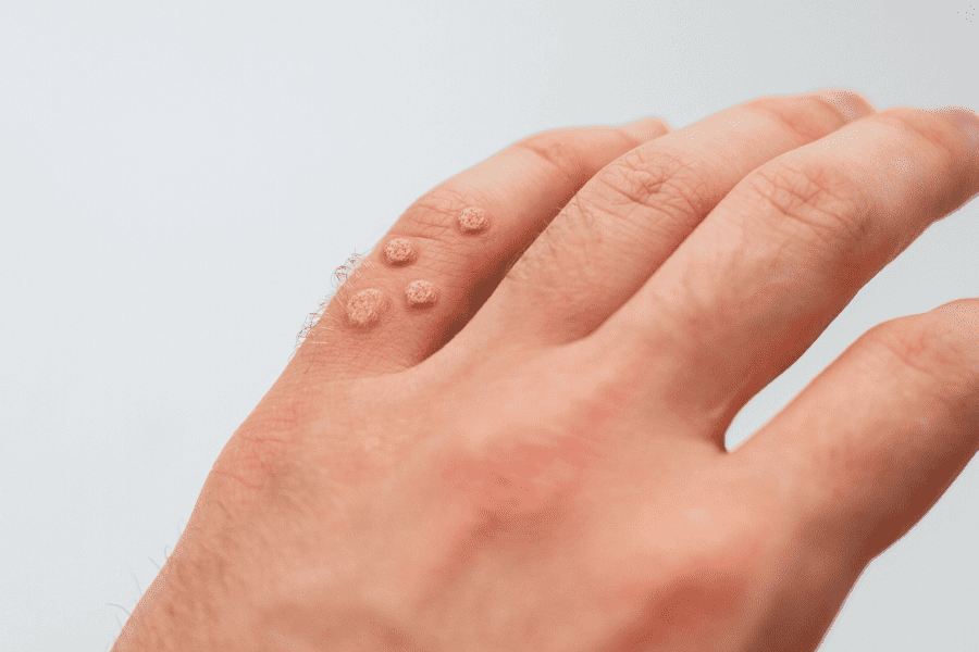 Comprehensive Guide to Wart Removal: Methods, Costs, and Laser Treatments