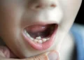 7 Signs Your Child May Need a Baby Tooth Root Canal