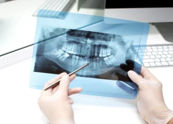 The Step-by-Step Plan to a Comfortable Surgical Wisdom Tooth Extraction