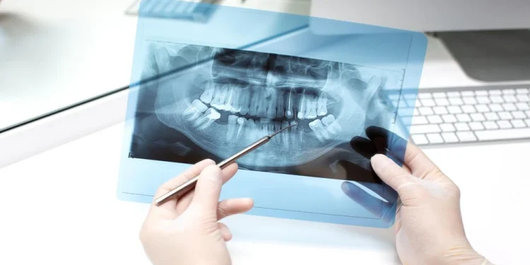 The Step-by-Step Plan to a Comfortable Surgical Wisdom Tooth Extraction